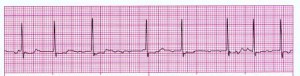 Atrial Fibrillation ECG strip 2