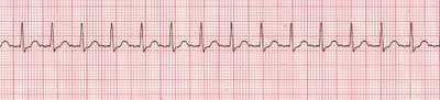 supraventricular tachycardia